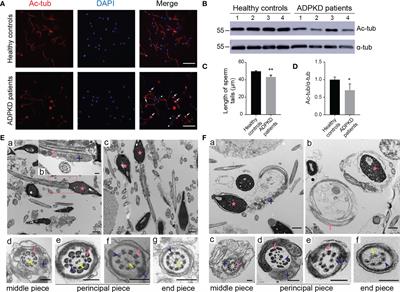 Sperm morphological abnormalities in autosomal dominant polycystic kidney disease are associated with the Hippo signaling pathway via PC1